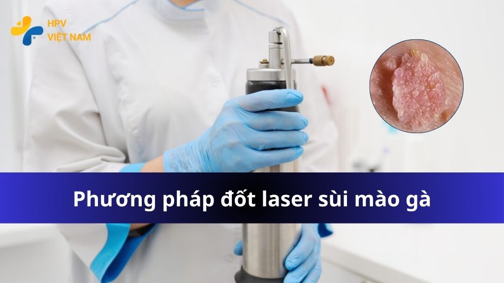 Phương pháp đốt sùi mào gà bằng laser