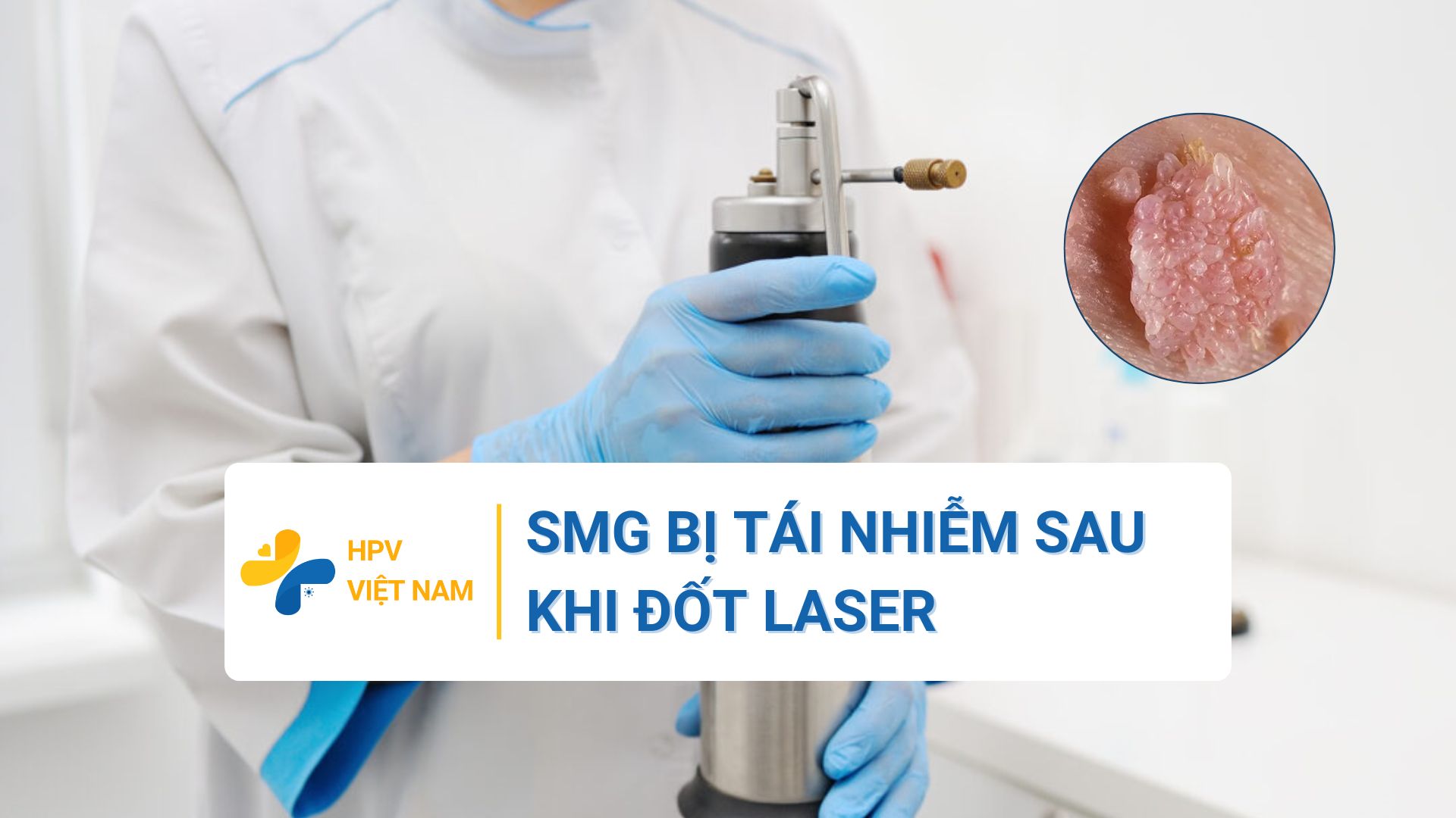 Sùi mào gà bị tái nhiễm sau khi đốt laser