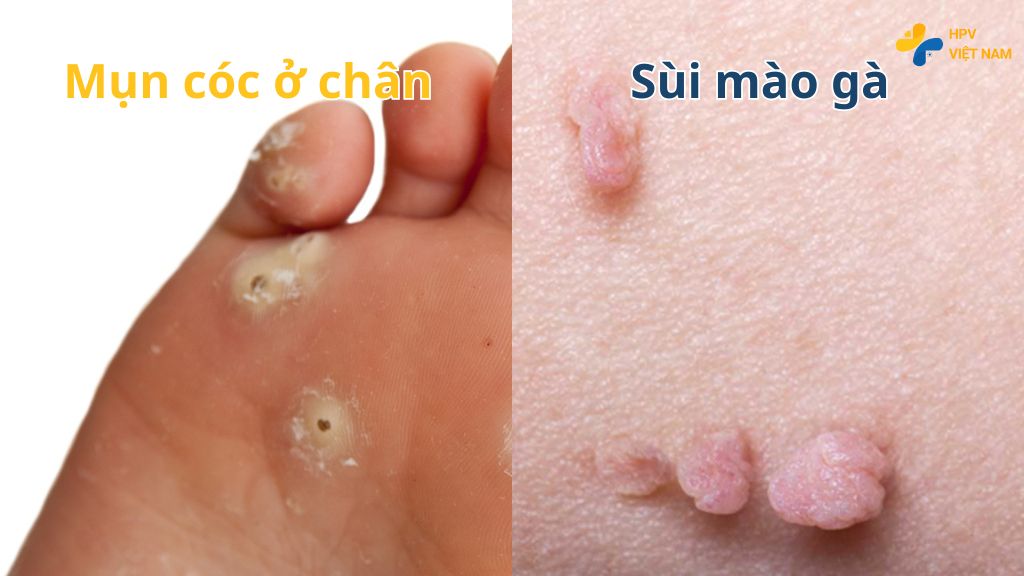 Phân biệt mụn cóc ở chân, tay và mụn cóc sinh dục