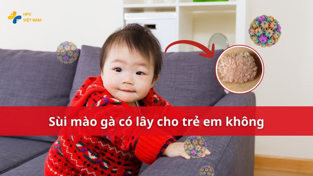 Sùi mào gà có lây cho trẻ em không