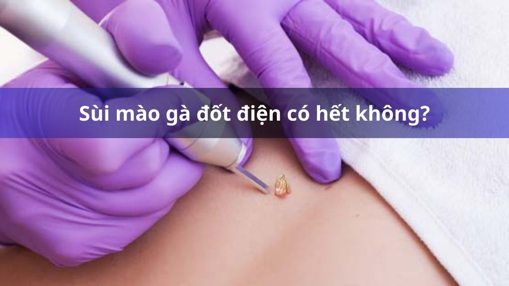 Sùi mào gà đốt điện có hết không?