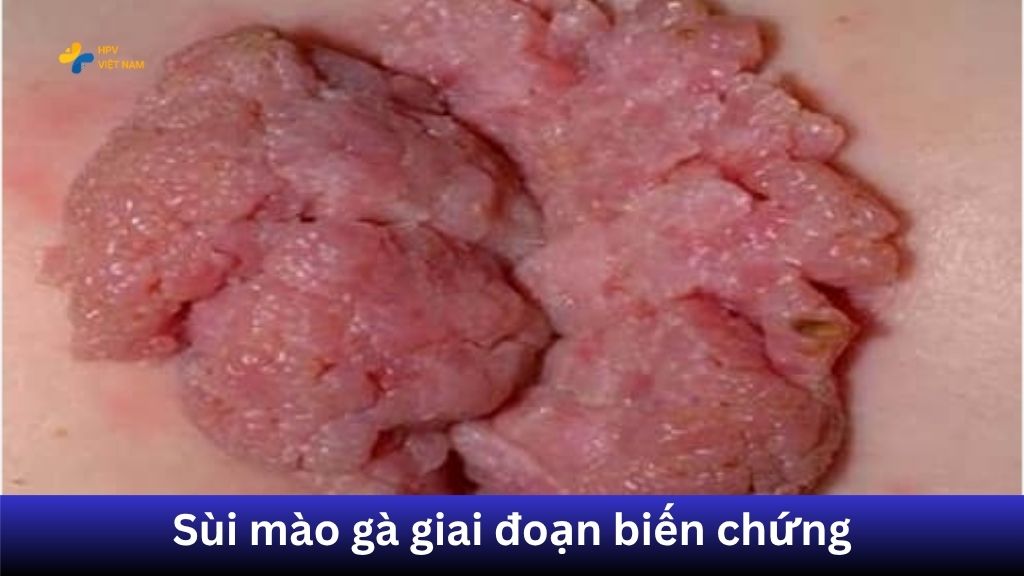 Hình ảnh sùi mào gà ở giai đoạn biến chứng