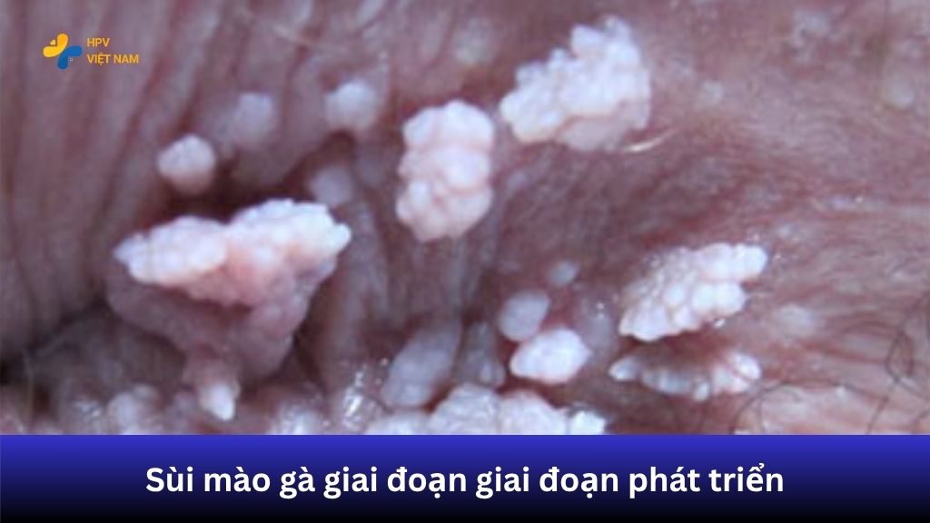 Giai đoạn phát triển: sùi lan rộng, dễ viêm loét, gây đau rát và khó chịu khi sinh hoạt