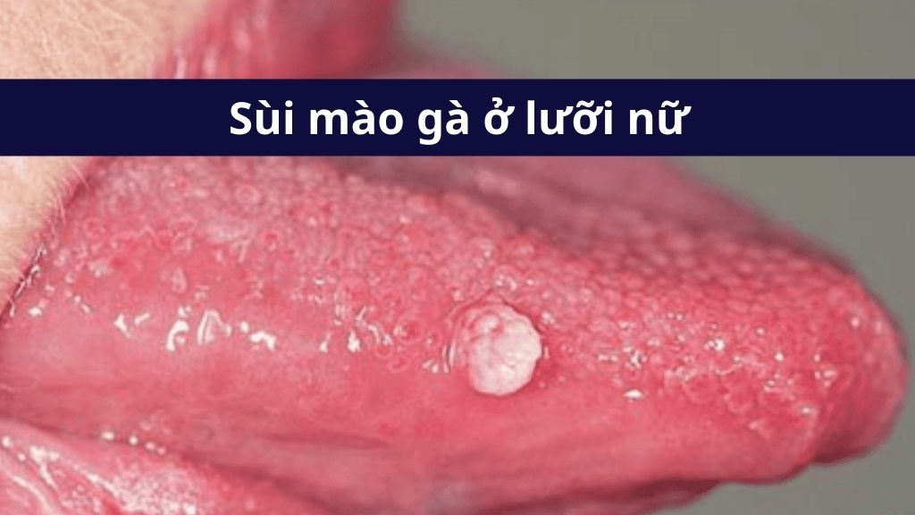 Sùi mào gà nữ ở lưỡi là gì?