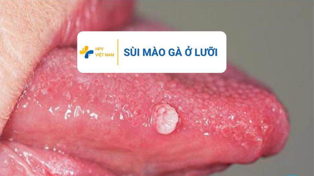Sùi mào gà ở lưỡi
