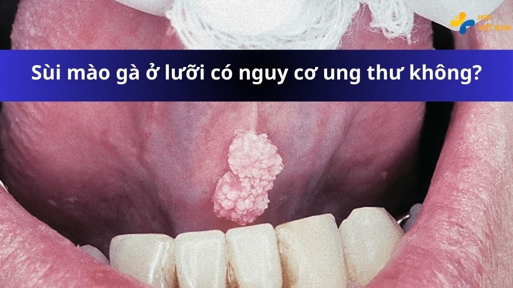 Sùi mào gà ở lưỡi có thể gây ung thư không?