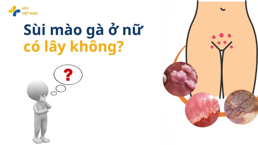 Sùi mào gà ở nữ có lây không