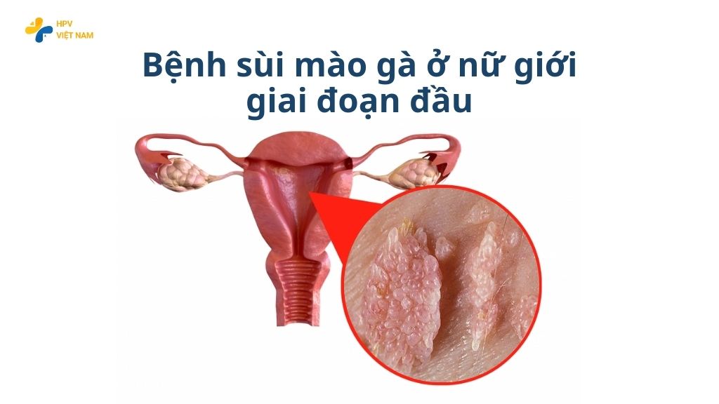 Sùi mào gà ở nữ giới giai đoạn đầu