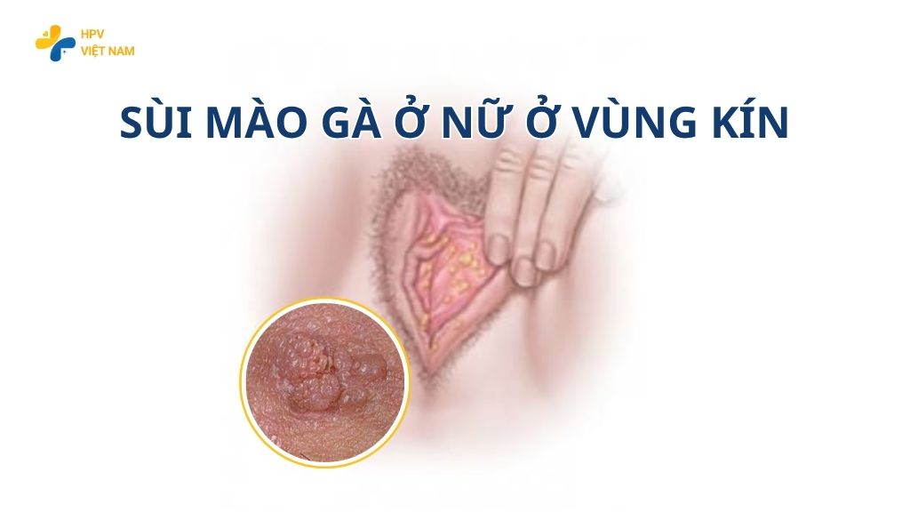 Sùi mào gà ở nữ ở vùng kín
