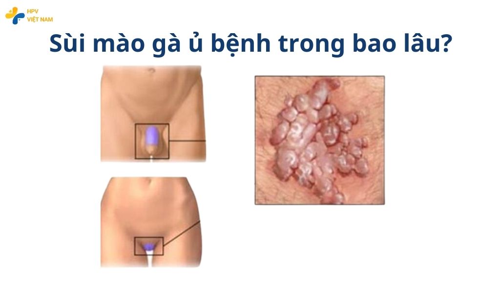 Sùi mào gà ủ bệnh trong bao lâu?