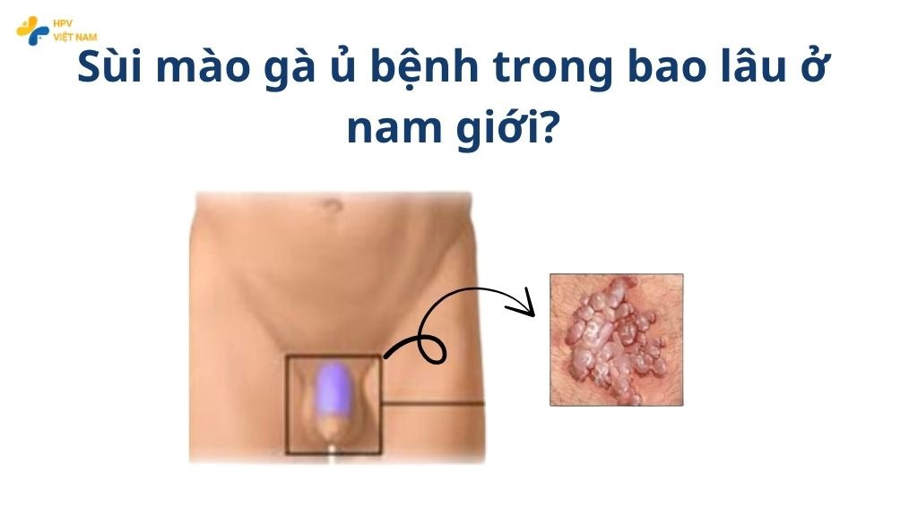 Sùi mào gà ủ bệnh bao lâu ở nam giới 