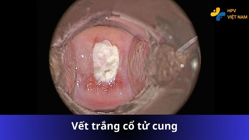 Vết trắng ở cổ tử cung