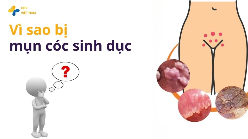 Vì sao bị mụn cóc sinh dục 